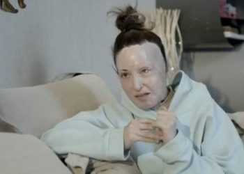 Ιωάννα Παλιοσπύρου: Έδειξε το πρόσωπό της και περιέγραψε τις δραματικές στιγμές της επίθεσης με βιτριόλι